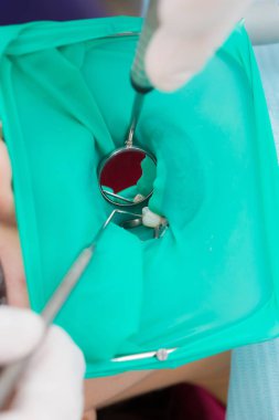 Yakın çekim Lateks plaka ağız boşluğu geri kalanından tedavi sırasında tedavi olmak için diş izole etmek için tasarlanmış. Diş hekimi diş tedavisi için hazırlanmış..