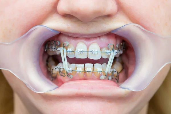 妇女的牙齿特写镜头与牙套和牵引器的嘴。牙医的病人-----------------------------多环钢丝绳拱门和弹性牵引的正畸治疗 — 图库照片