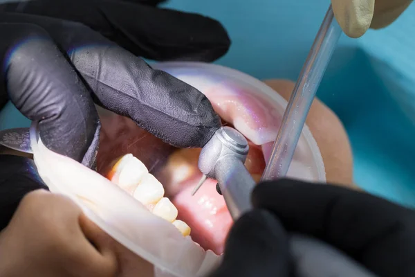 Primer plano de la mano del dentista perforando los dientes y rociando el agua — Foto de Stock