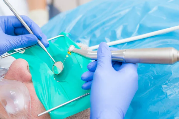 Imagem de perto de instrumentos dentários: broca e agulha para o tratamento do canal radicular e pulpite na mão no dentista — Fotografia de Stock