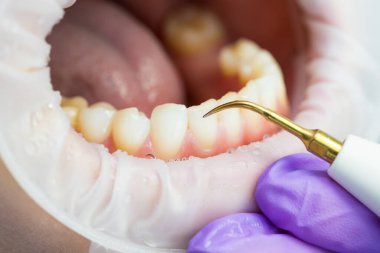 Ultrasonik diş temizliği, yakın plan. Tartar ve plaketin çıkarılması. Paradontitis, paradantoz.
