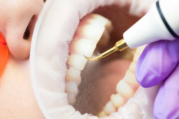 Ultrasonik diş temizliği, yakın plan. Tartar ve plaketin çıkarılması. Paradontitis, paradantoz. — Stok fotoğraf