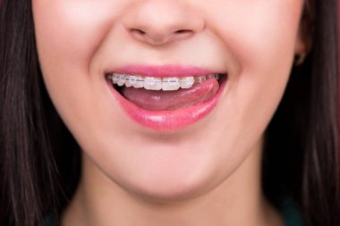 Smiling happy woman mouth with tongue and braces clipart