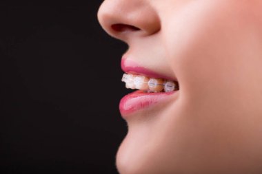 Diş telleri. Güzel, sağlıklı bir gülümseme. Yaklaş. Dişlerin üzerindeki seramik diş telleri. Diş telleriyle gülümseyen güzel bir kadın. Ortodontik tedavi. Güzel Dudaklar ve Dişler