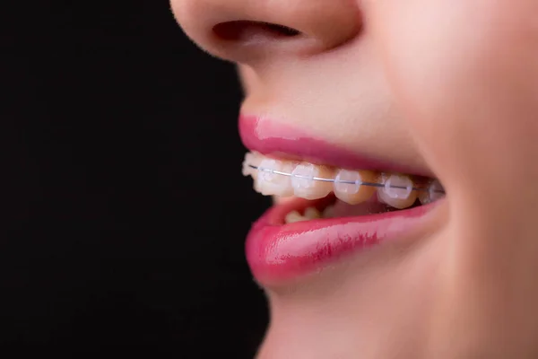 Tirantes. Mujer hermosa sonrisa sana de cerca. Frenos cerámicos de primer plano en los dientes. Hermosa sonrisa femenina con tirantes. Ortodoncia Tratamiento . — Foto de Stock