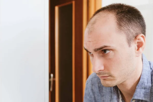 Male pattern hair loss problem concept. Young caucasian man looking at mirror worried about balding. Baldness, alopecia in males.