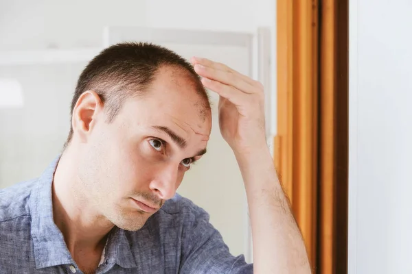 Male pattern hair loss problem concept. Young caucasian man looking at mirror worried about balding. Baldness, alopecia in males.
