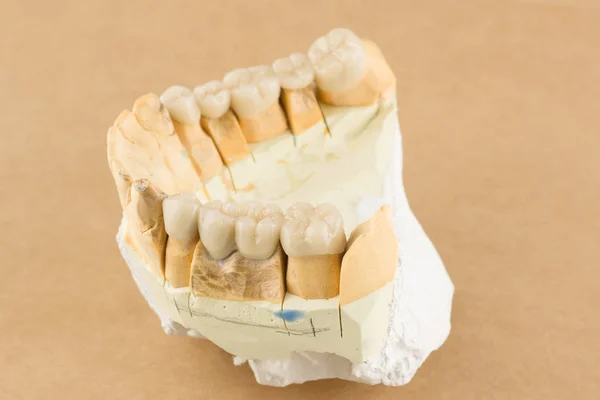 Estructuras Dentales Artificiales Cerámica Para Restauración Dentición —  Fotos de Stock