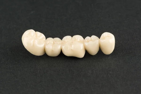 Strutture Odontoiatriche Artificiali Ceramica Restauro Della Dentizione — Foto Stock