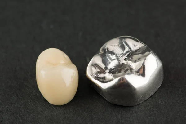 Giess Und Cermet Zahnstrukturen Zur Wiederherstellung Der Zähne — Stockfoto