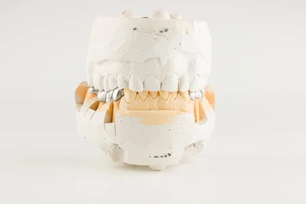 Bases Metal Cast Bridges Artificial Dental Model — Stock Photo, Image