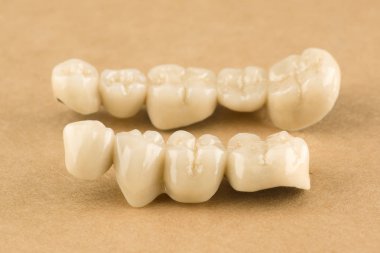 Seramik diş restorasyonu için yapılan yapay diş yapıları
