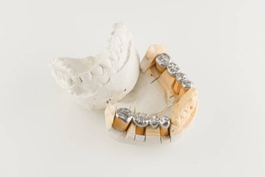 metal döküm köprü bir yapay diş modeli temelleri