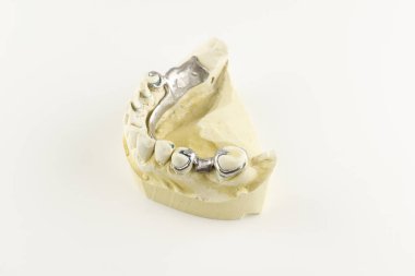 Alçı model toka protezin çelik Bankası