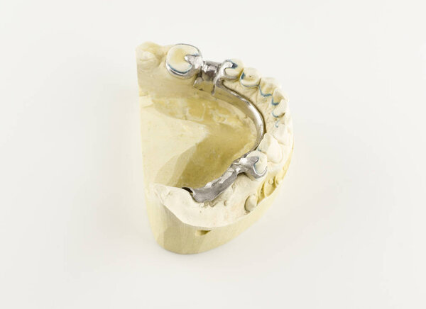 стальная основа протеза застежки на гипсовой модели
