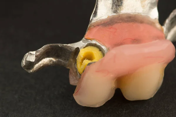 黒の背景上のアタッチメントでモダンなアークの義歯のイメージ — ストック写真