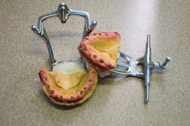 maruz dental implantlar ile diş alçı model