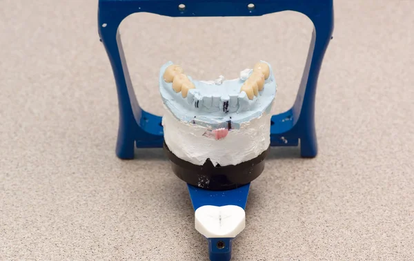 Zahnartikulator mit eingegipsten Zahnmodellen — Stockfoto