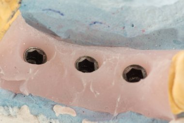 dental implantların yapay analogları ile model