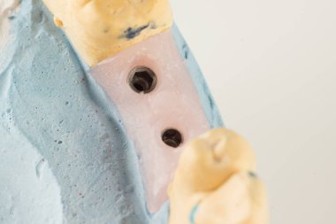 dental implantların yapay analogları ile model