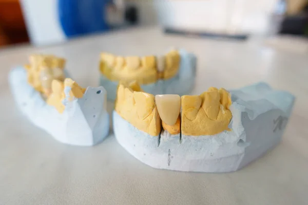 Metal ceramic dental crowns on artificial gypsum models — Stock Photo, Image