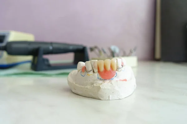 Τεχνητή αφαιρούμενη οδοντιατρική πρόθεση — Φωτογραφία Αρχείου