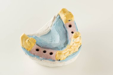 dental implantların yapay analogları ile model