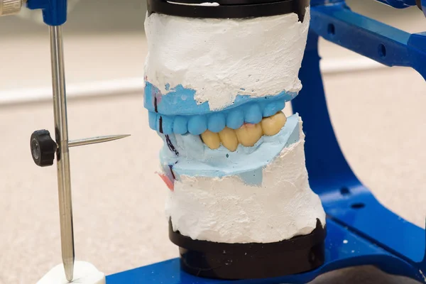 Dental articulator with plastered dental  models — Stock Photo, Image