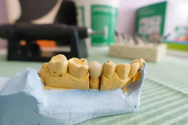 Dentista examina coronas dentales artificiales en un modelo — Foto de Stock