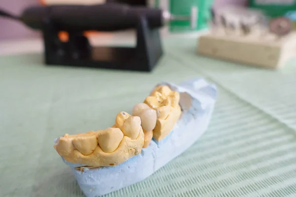 Dentysta bada sztuczne korony stomatologiczne na modelu — Zdjęcie stockowe