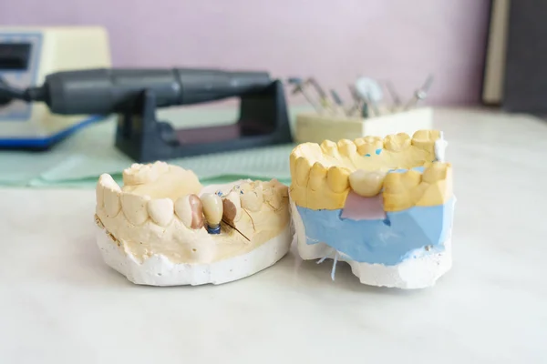 Metal ceramic dental crowns on artificial gypsum models — Stock Photo, Image