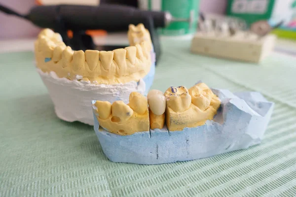 Οδοντίατρος εξετάζει τεχνητές οδοντιατρικές κορώνες σε ένα μοντέλο — Φωτογραφία Αρχείου