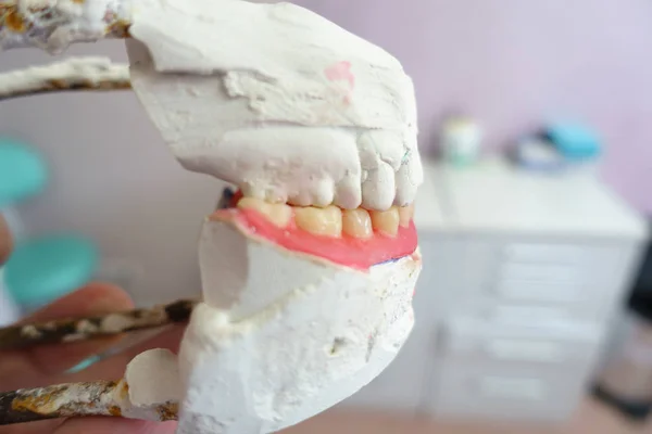 Dentadura removível nas mãos de um médico — Fotografia de Stock