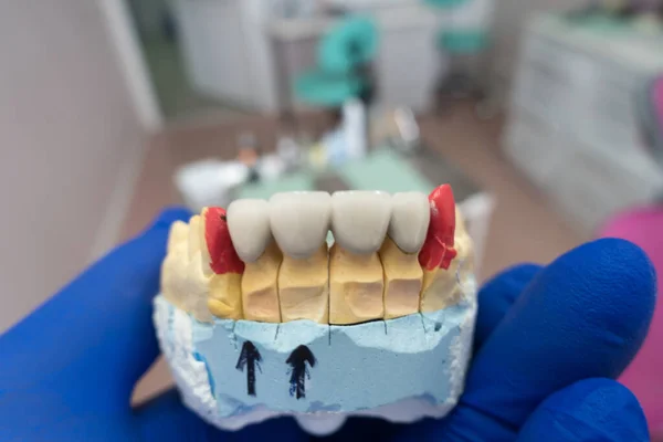 Structures Dentaires Artificielles Entre Les Mains Dentiste — Photo