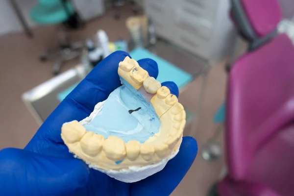 Bliska Ceramiczna Korona Zęba Gipsowym Modelu Zębów Dłoni Dentysty Praca — Zdjęcie stockowe