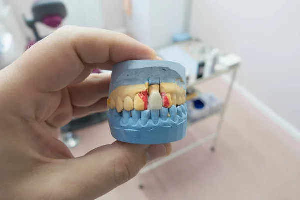 dental ceramic metal crowns on a plaster model in the doctors hand