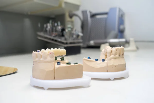 Coronas Dentales Circonia Modelos Dentales Laboratorio Dental — Foto de Stock
