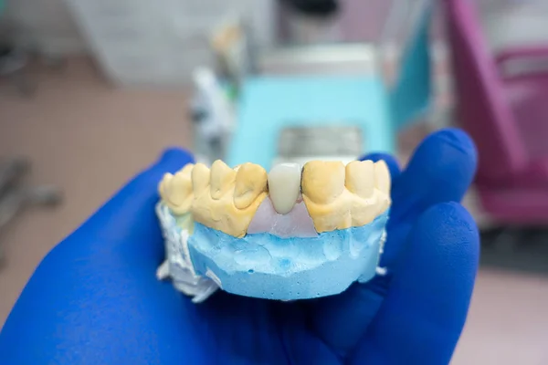 Bliska Ceramiczna Korona Zęba Gipsowym Modelu Zębów Dłoni Dentysty Praca — Zdjęcie stockowe