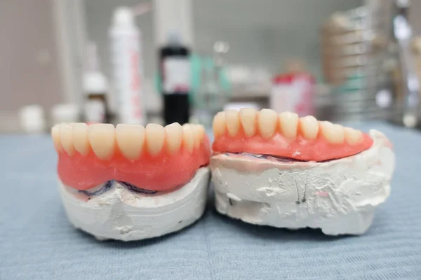 Kompletne Wyjmowane Protezy Dentystyczne Modelach Gipsowych Procesie Produkcyjnym — Zdjęcie stockowe