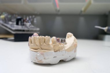 Diş implantı olan insan çenesinin alçı taşı modeli