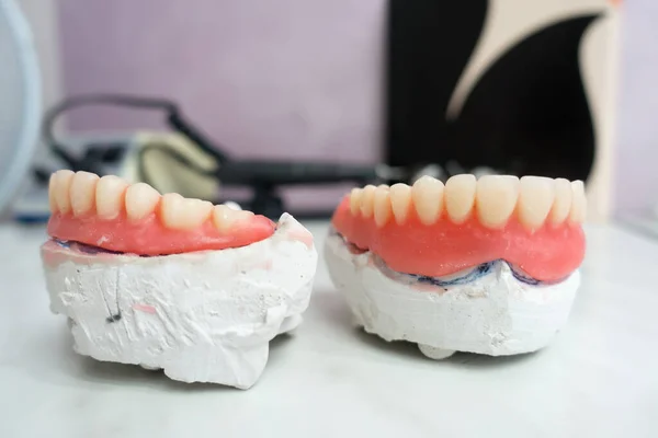 製造工程における石膏モデルの完全な取り外し可能な歯科用義歯 — ストック写真