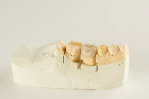 Couronne Dentaire Céramique Métallique Photographiée Gros Plan Sur Fond Blanc — Photo