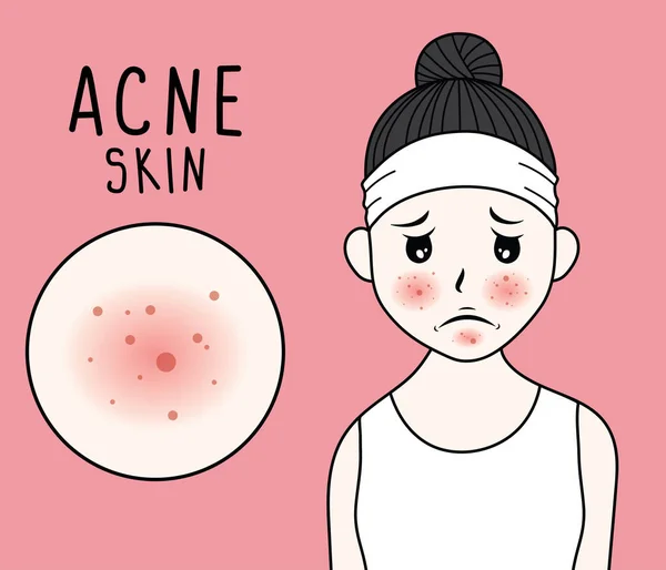 Gezicht Van Vrouw Van Vector Acne Voor Huid Zorg Illustratie — Stockvector