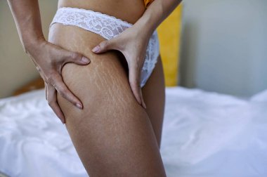 Bir kızın kalçasındaki deride gerilme izleri var. Bacaklardaki Esneme İzleri.