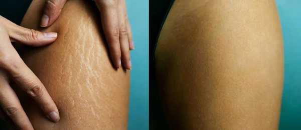 女性髋关节伸展标记在女性腿上的前后照片 — 图库照片