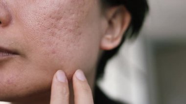 Kadınların yüzündeki sivilce üstüne yara izleri. Cilt tedavisi sorunu. Kapat..