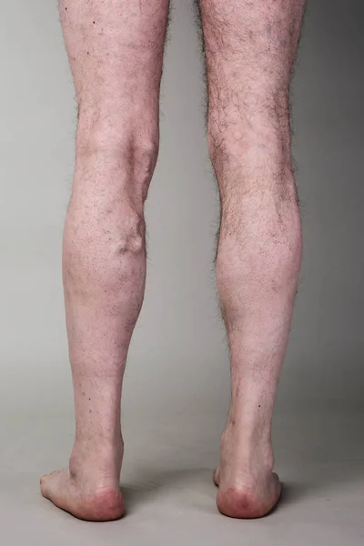 Tight varicose vein on a mans legs.