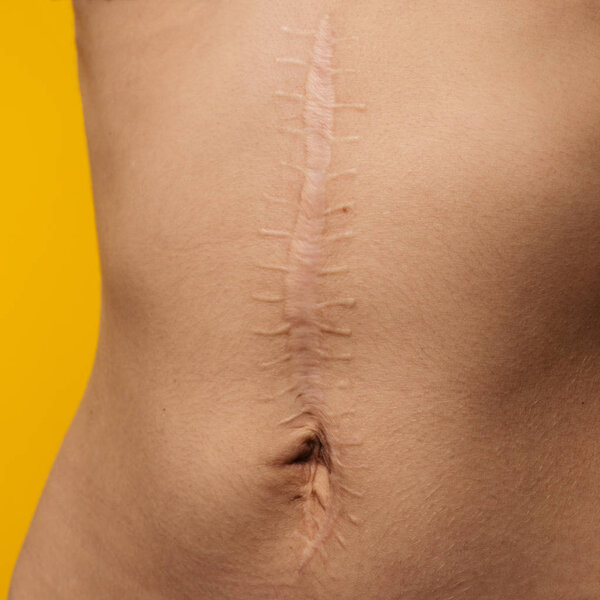scars removal concept, large scar after surgery on the abdomen young woman, yellowl background, selective focus