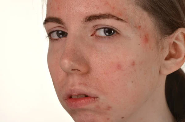 Beautiful young girl with problematic skin, acne problem concept — Stock Photo, Image