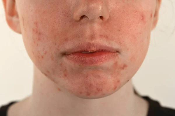 Post-akne, hegek és piros színez pattanások az arcon egy fiatal nő. a bőrproblémák és a harmonikus kudarc fogalma — Stock Fotó